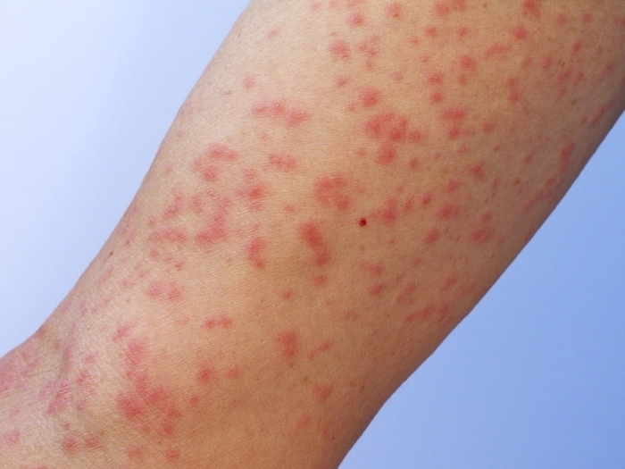 アレルギーと過敏症の違いは何ですか?